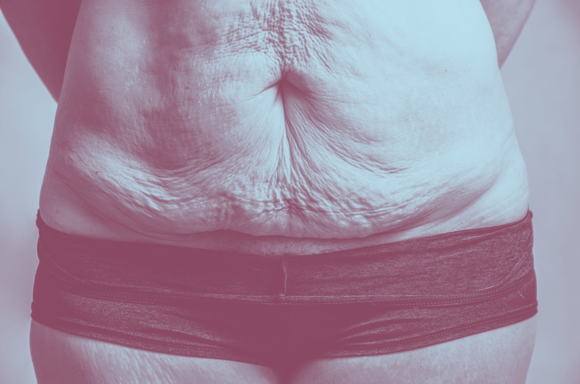 How To Remove Unwanted Stretch Marks After Weight Loss